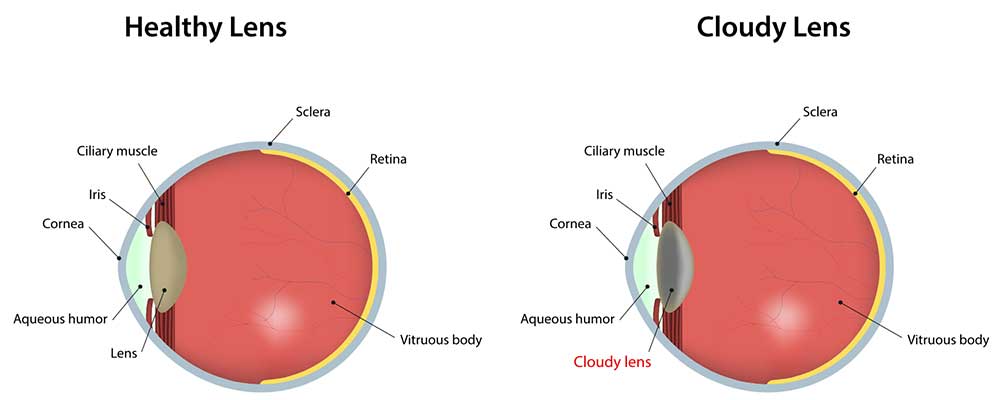 cataract healthy lens and cloudy lens