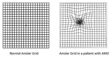 Amsler grid comparison showing normal vision and vision affected by macular degeneration